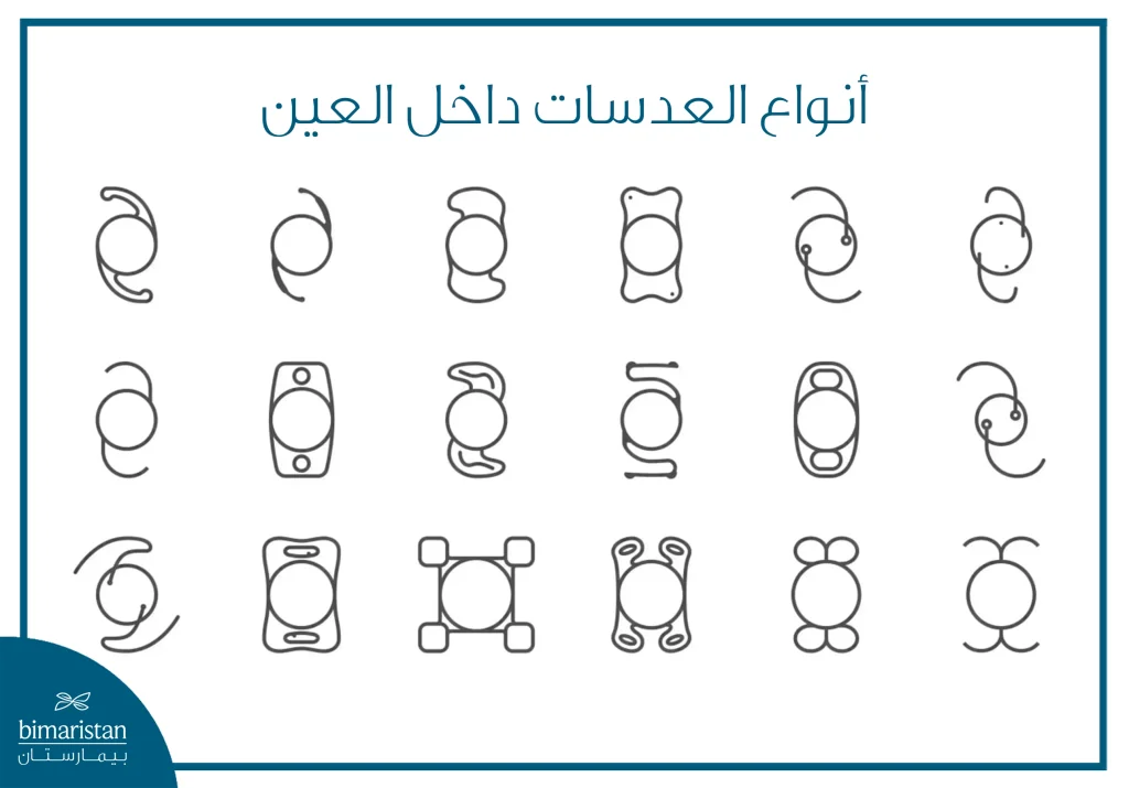 رسم تخطيطي يوضح أشكالاً مختلفة للعدسات المزروعة داخل العين، ويُظهر تنوع تصميم العدسات المستخدمة في جراحات زراعة العدسات واختلاف آليات تثبيتها داخل العين.