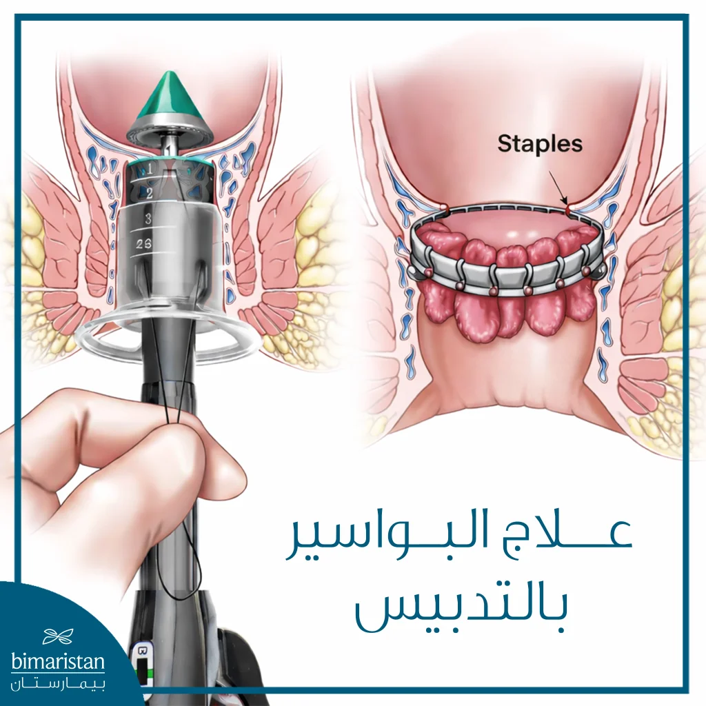 علاج البواسير بالتدبيس: مزايا العملية والتكلفة 5 توضح الصورة مبدأ علاج البواسير بالتدبيس، حيث تقوم الدباسة بإزالة حلقة من الغشاء المخاطي المستقيمي فوق الخط المسنن، مع إعادة وضع أنسجة البواسير المتدلية