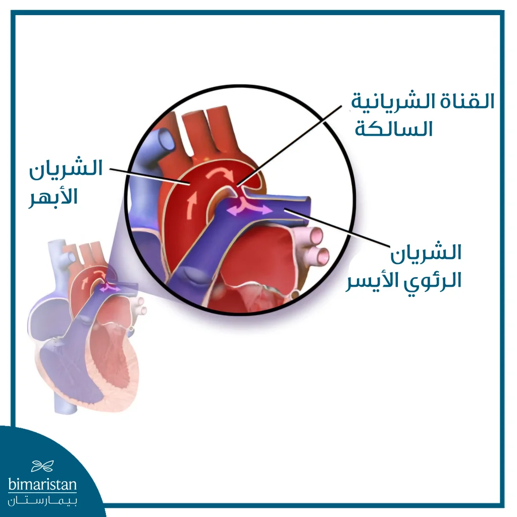 رسم تشريحي يوضح القناة الشريانية السالكة (Pda) ومسار تدفّق الدم غير الطبيعي بين الشريان الأبهر والشريان الرئوي الأيسر، مع إبراز موقع القناة وتأثيرها على الدورة الدموية القلبية