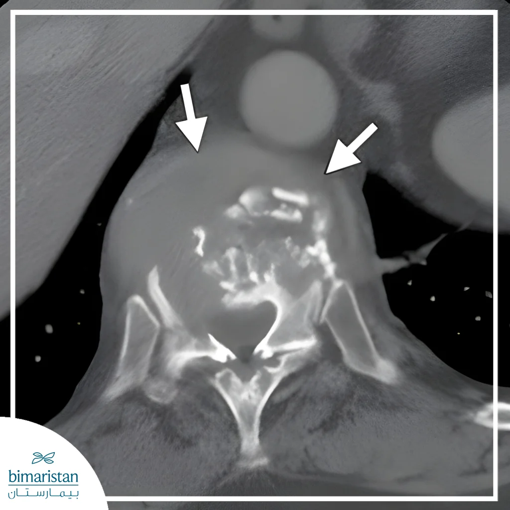 A Ct Scan Image Showing A Tumor In The Spine+