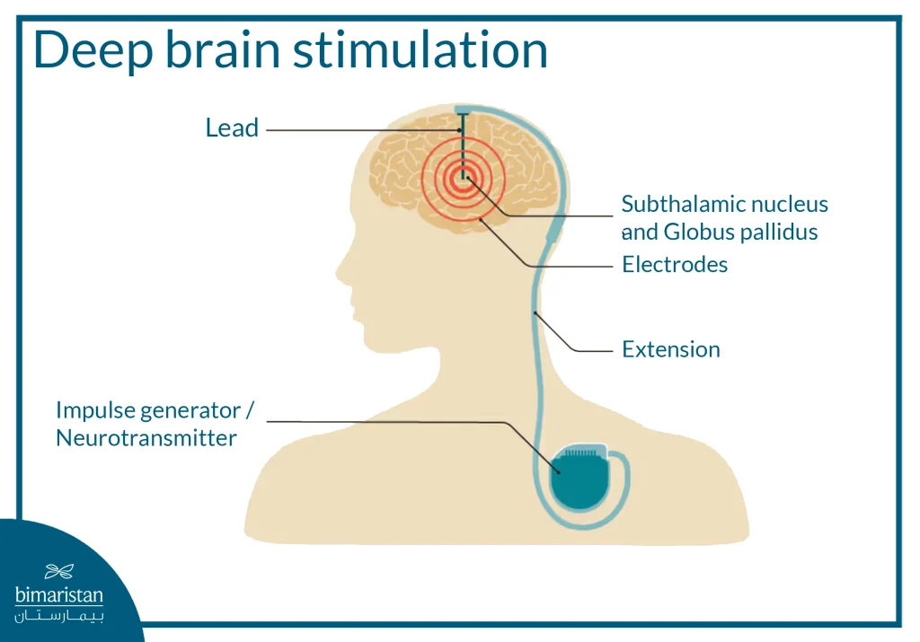 Parkinson'S Hand Tremor: When Is It An Early Symptom And How Is It Treated? 4 A Simplified Image Of Deep Brain Stimulation