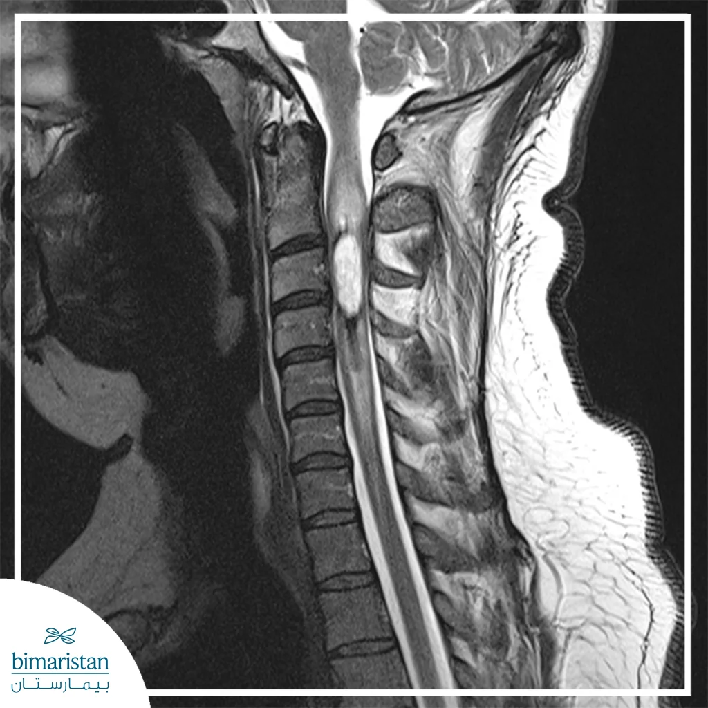 An Mri Image Showing A Clearly Visible Tumor In The Spine