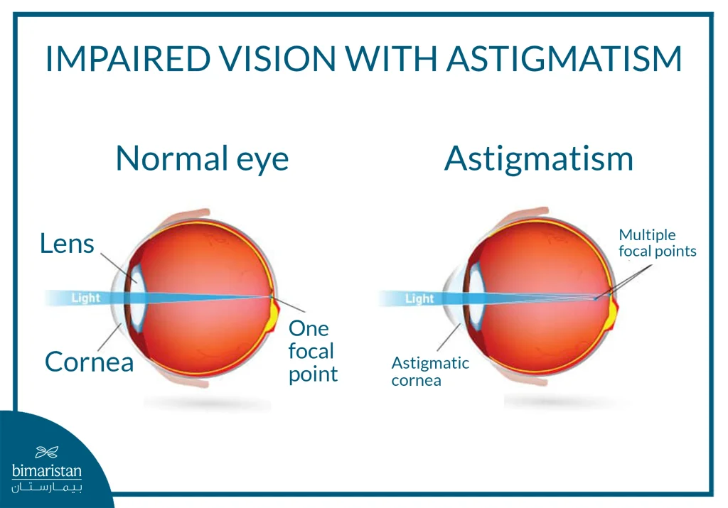 Toric Lens: The Precise Solution For Correcting Astigmatism During Cataract Surgery 3 An Illustration Comparing A Normal Eye And An Astigmatic Eye, Showing A Single Focal Point In Normal Vision Versus Multiple Focal Points Caused By An Irregular Cornea In Astigmatism.