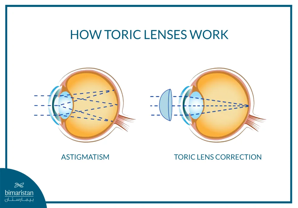 Toric Lens: The Precise Solution For Correcting Astigmatism During Cataract Surgery 2 An Illustration Showing How Toric Lenses Correct Astigmatism By Aligning Light Rays Properly, Compared To The Distorted Light Focus Seen In Astigmatic Eyes.