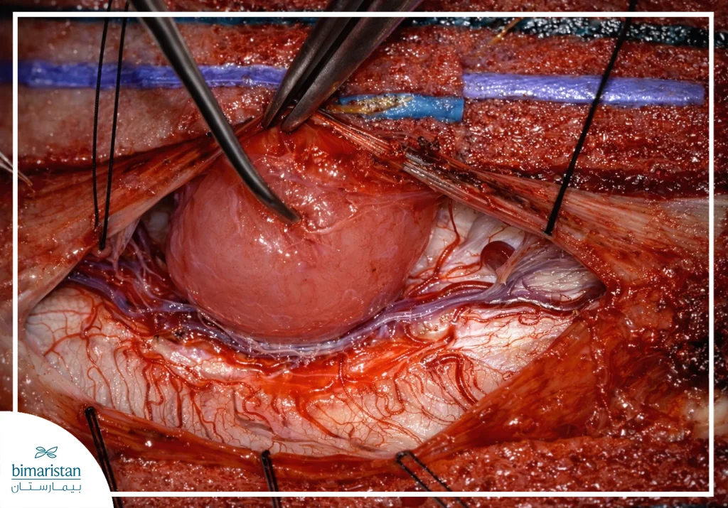 An Image Showing A Surgical Removal Of A Tumor In The Spinal Column