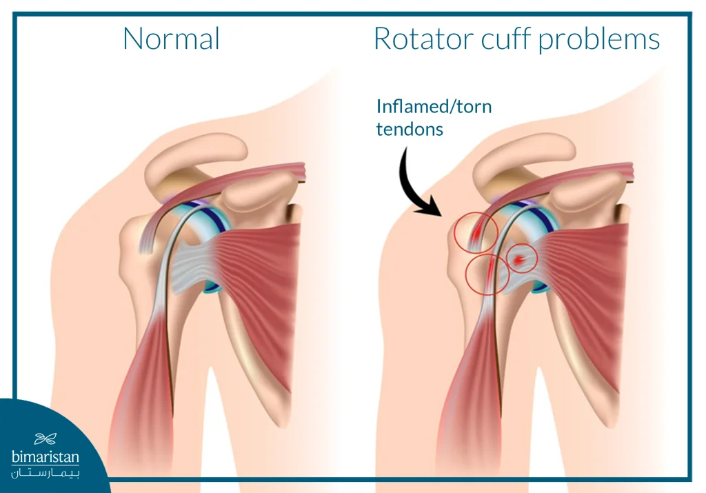 An Image Showing Shoulder Tendon Rupture