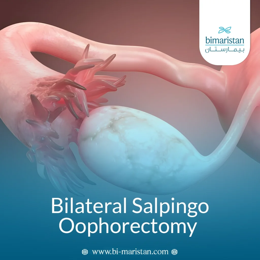 Bilateral Salpingo-Oophorectomy