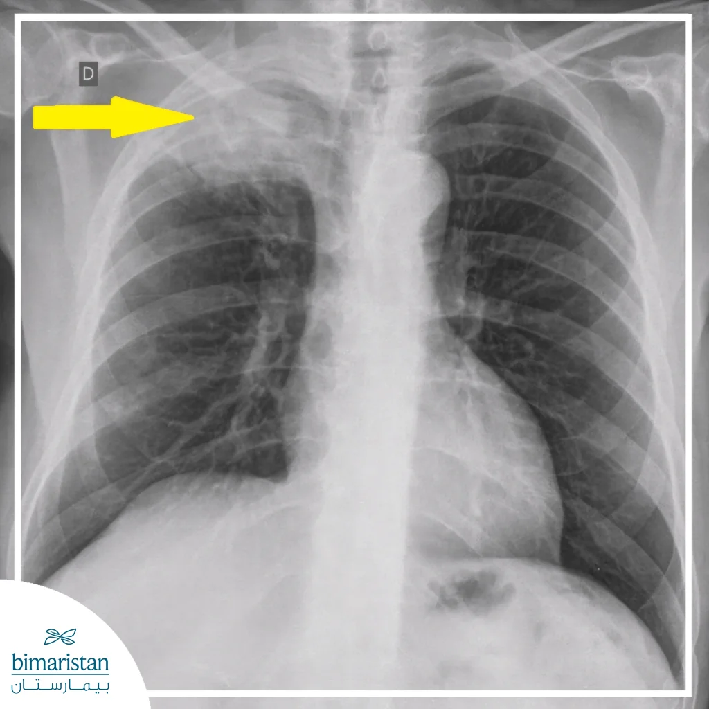 Pancoast Tumor Overview: Causes, Symptoms, And Effective Treatment Strategies 4 Chest X-Ray Image Showing An Apical Lung Mass Indicated By An Arrow, A Typical Radiographic Appearance Seen In Pancoast Tumors