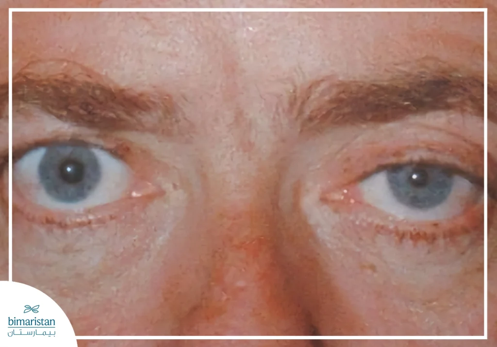 Pancoast Tumor Overview: Causes, Symptoms, And Effective Treatment Strategies 3 Close-Up Image Of A Face Showing Unilateral Eyelid Drooping And Pupil Constriction, Characteristic Clinical Signs Of Horner Syndrome Associated With Pancoast Tumor