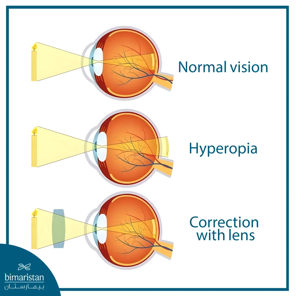 Diagram Comparing Normal Vision, Hyperopia, And Correction With A Lens, Showing How Light Focuses Behind The Retina In Hyperopia And Is Corrected By A Lens