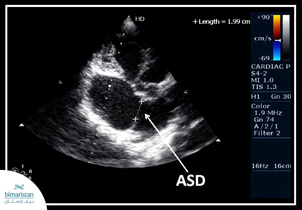 Echocardiography Image Showing An Atrial Septal Defect, With The Defect Location Highlighted And Its Size Measured Within The Atrial Septum