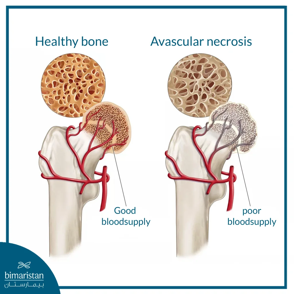 Difference Between Normal And Necrotic Bone