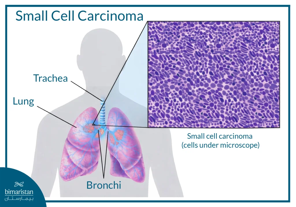 Illustration Showing The Location Of Small Cell Lung Cancer In The Lung And The Appearance Of Cancer Cells Under The Microscope
