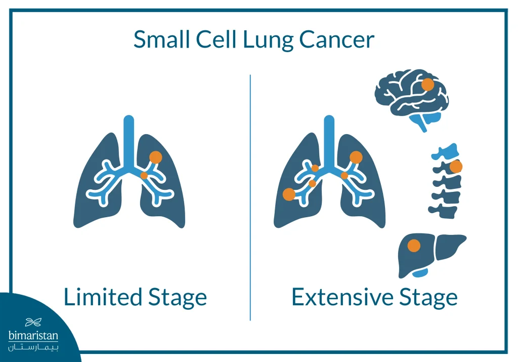 Image Showing The Difference Between Limited Stage And Extensive Stage Small Cell Lung Cancer