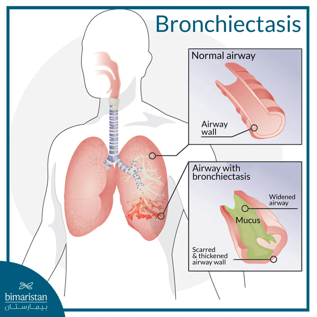 Bronchiectasis Treatment Guide: Latest Care And Therapy Options 3 Medical Illustration Showing Bronchiectasis In The Lungs, Comparing A Normal Airway With A Widened Airway Containing Mucus