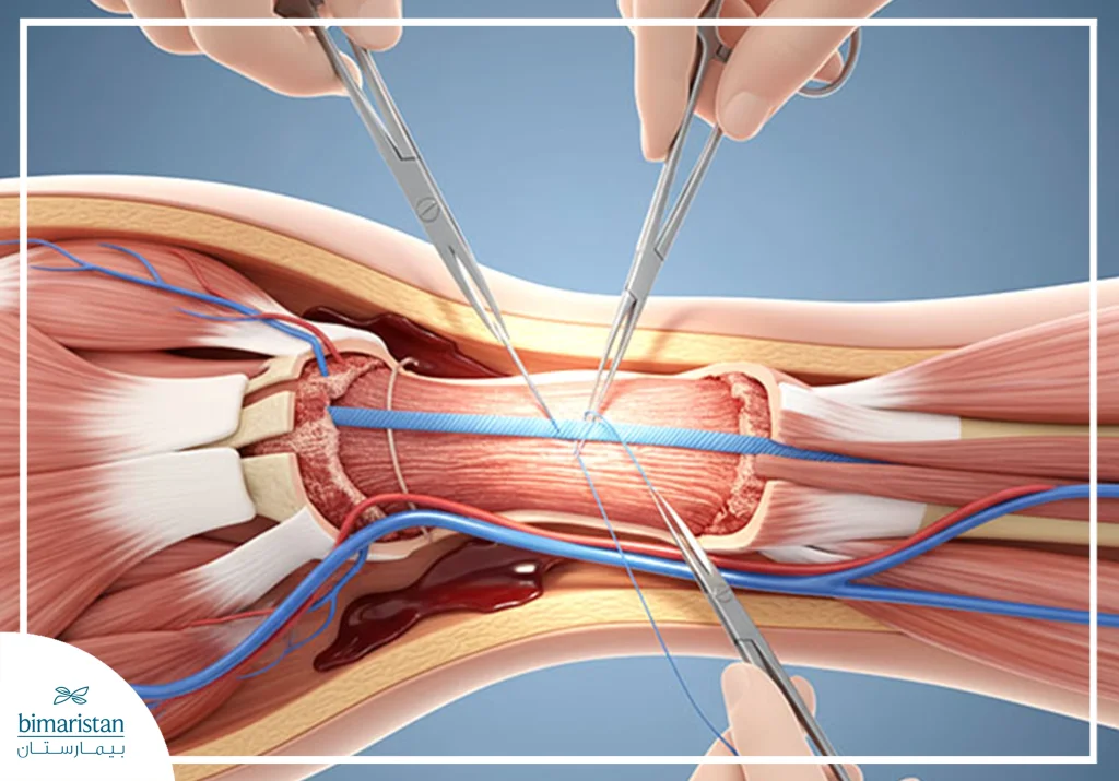 Open Surgical Repair Of Tendons