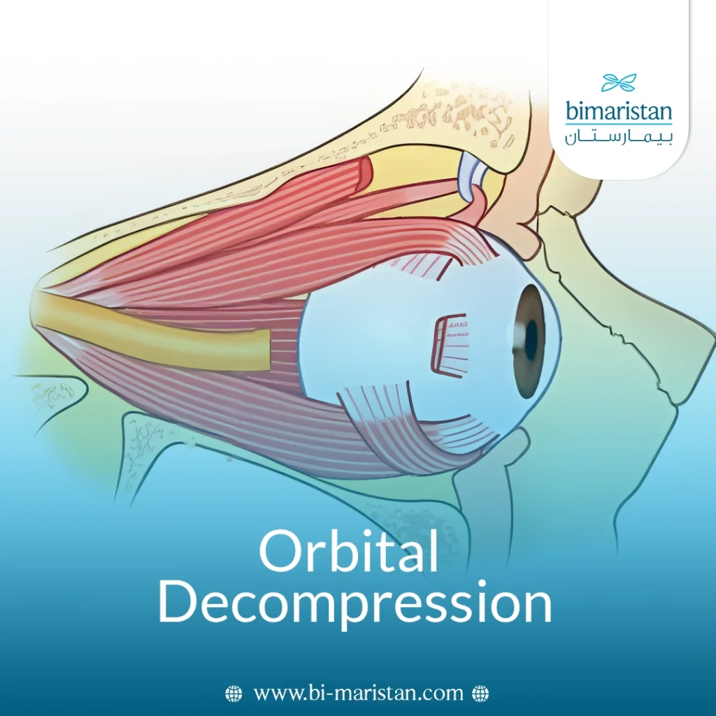 Orbital Decompression