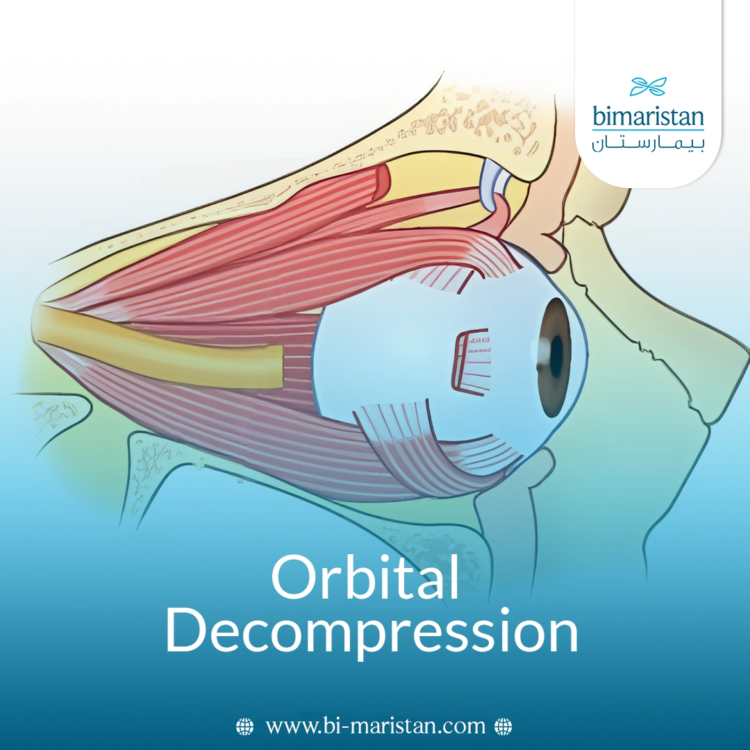 Orbital Decompression