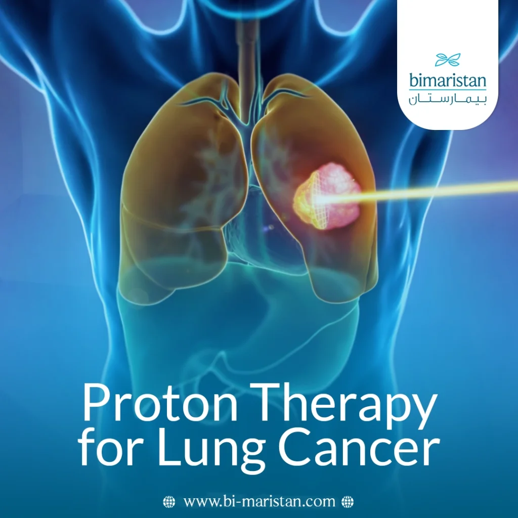 Proton Therapy For Lung Cancer