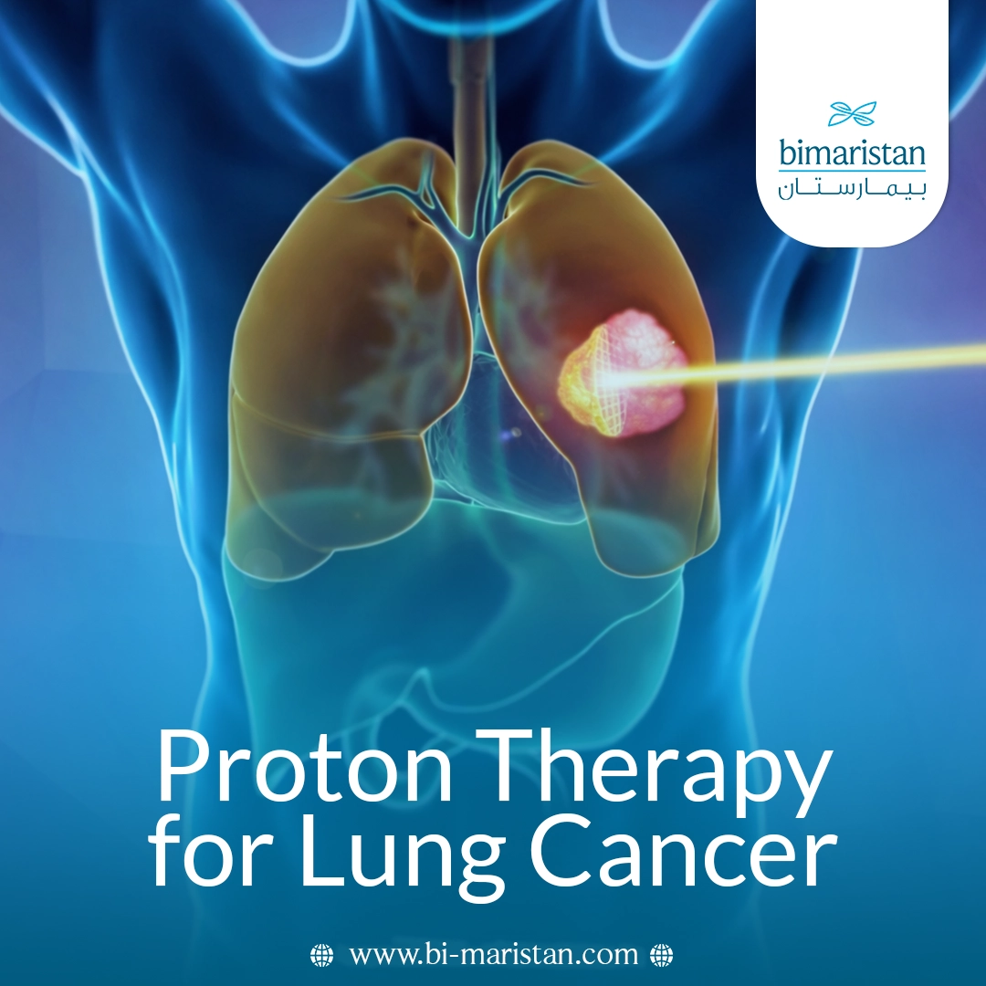 Proton Therapy For Lung Cancer