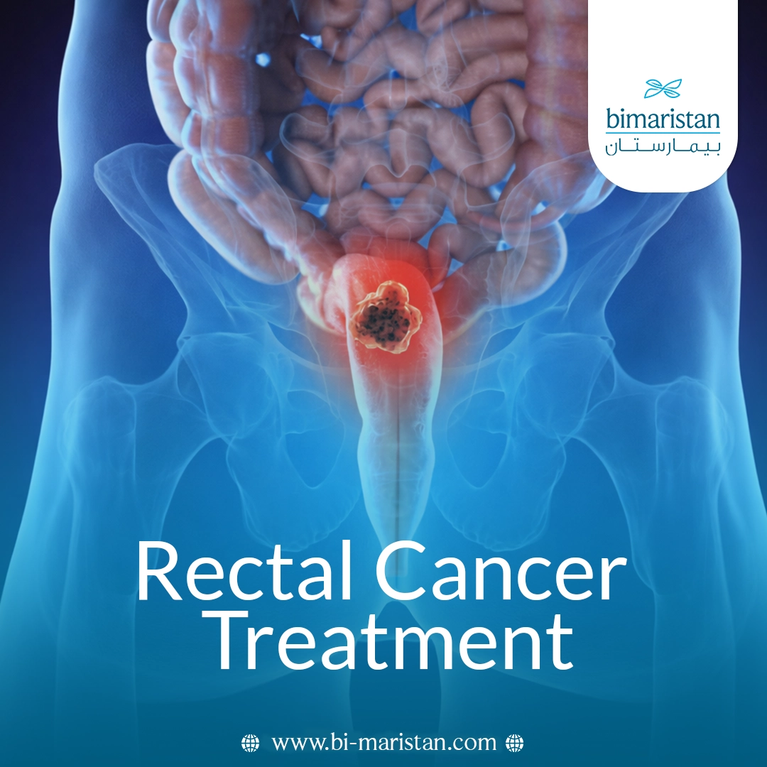 Rectal Cancer Treatment