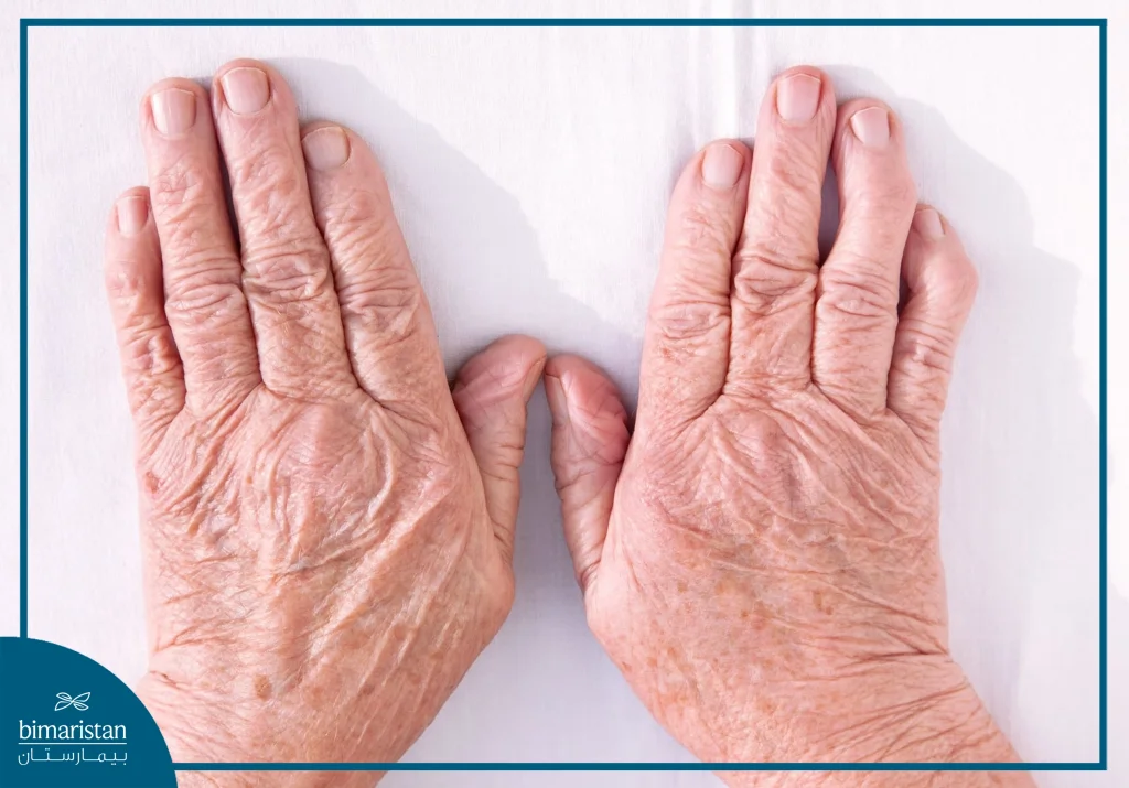 Rheumatoid Arthritis One Of The Most Important Causes Of Tendon Rupture