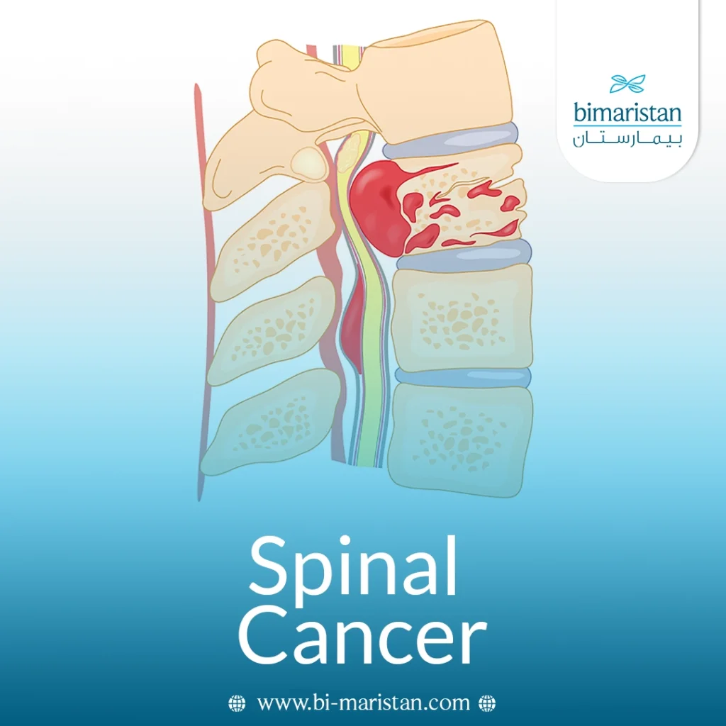 Spinal Cancer