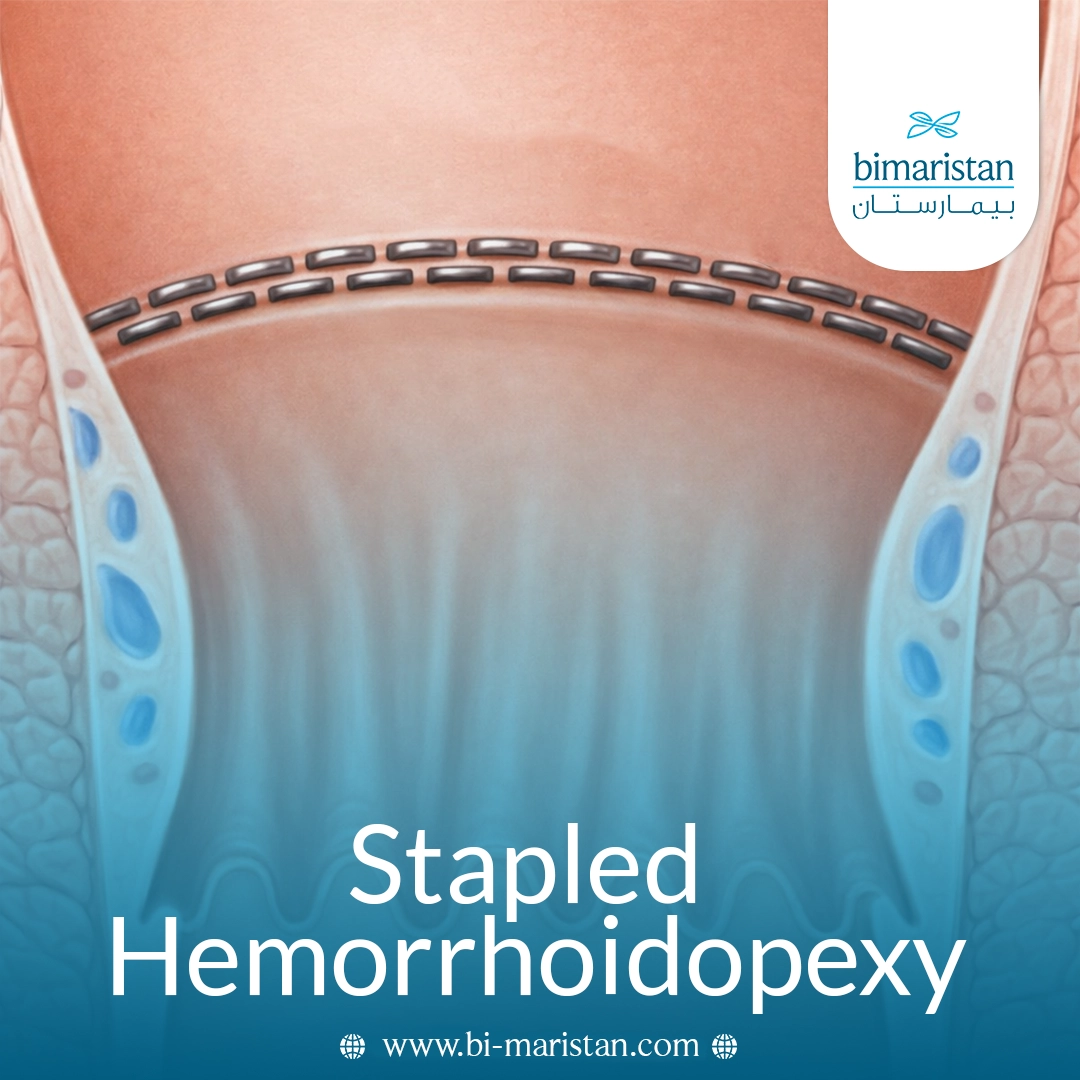 Stapled Hemorrhoidopexy