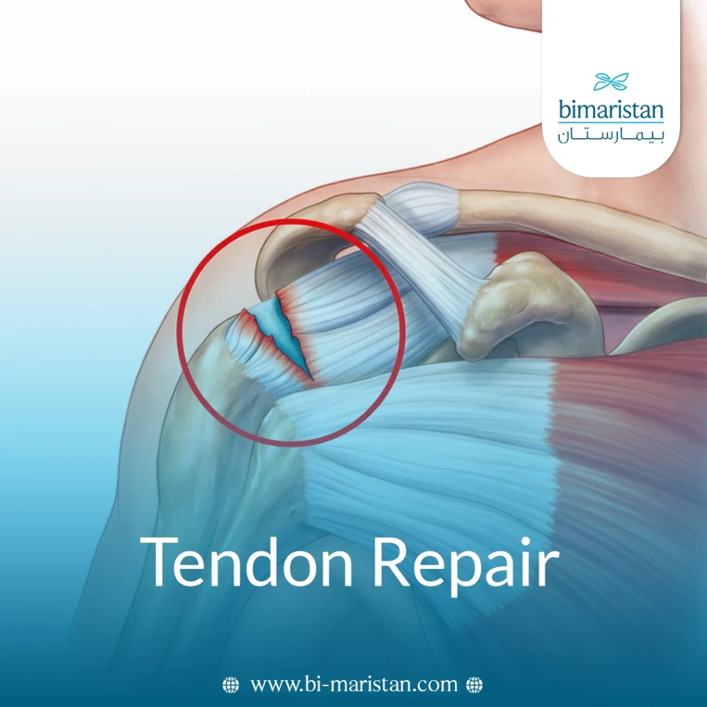 Tendon Repair