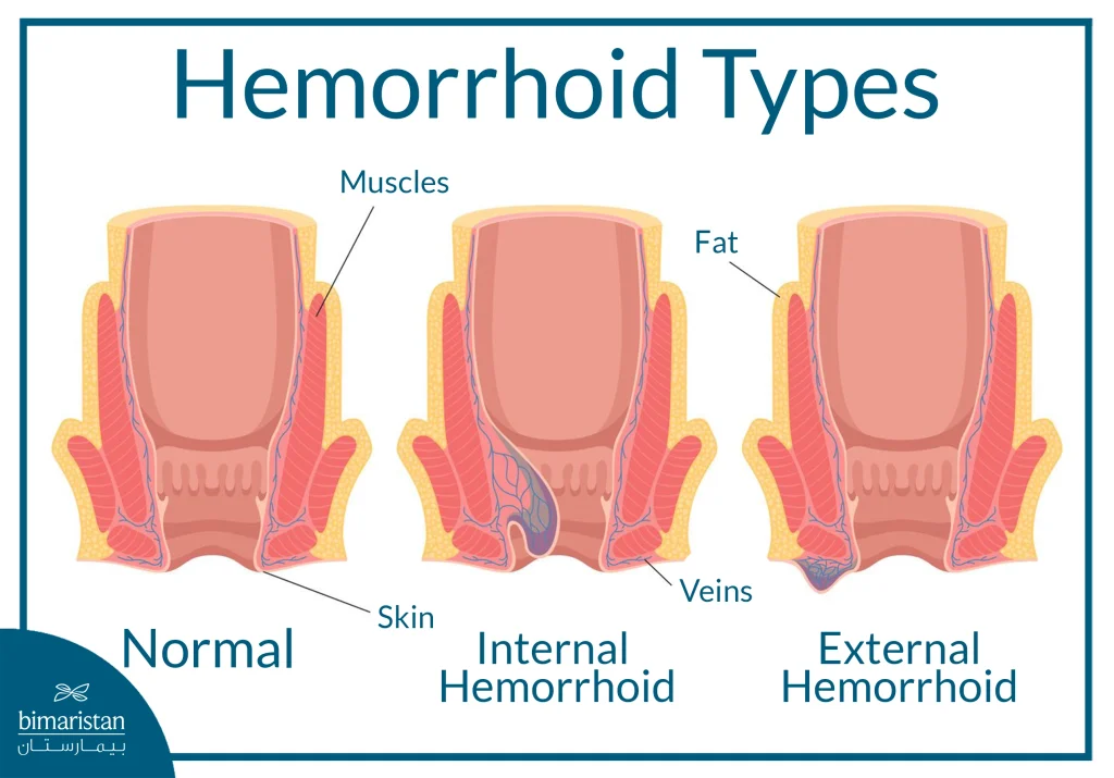 Stapled Hemorrhoidopexy: Benefits, Procedure Details, And Treatment Costs 3 The Image Illustrates The Types Of Hemorrhoids