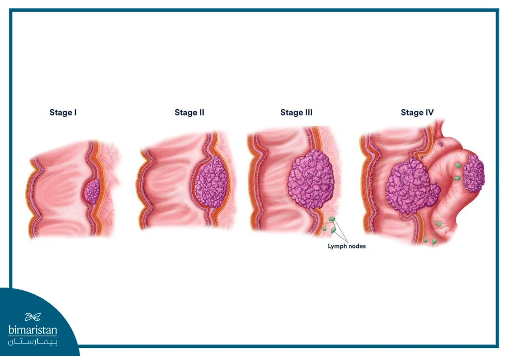 The Image Shows The Stages Of Rectal Cancer.
