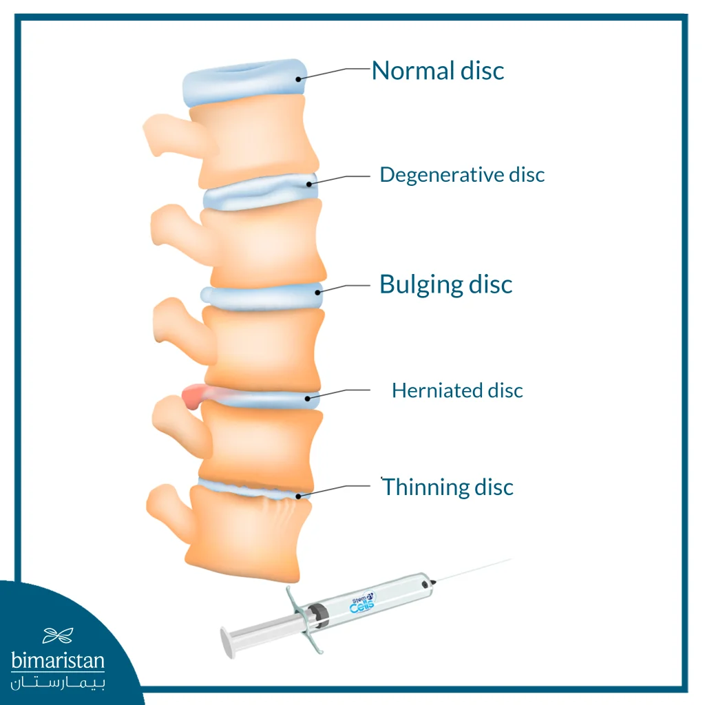 The Most Important Cartilage Conditions That Can Be Treated With Stem Cells