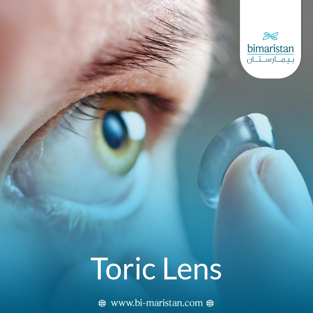 Toric Lens