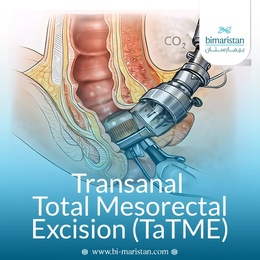 Transanal Total Mesorectal Excision (Tatme)