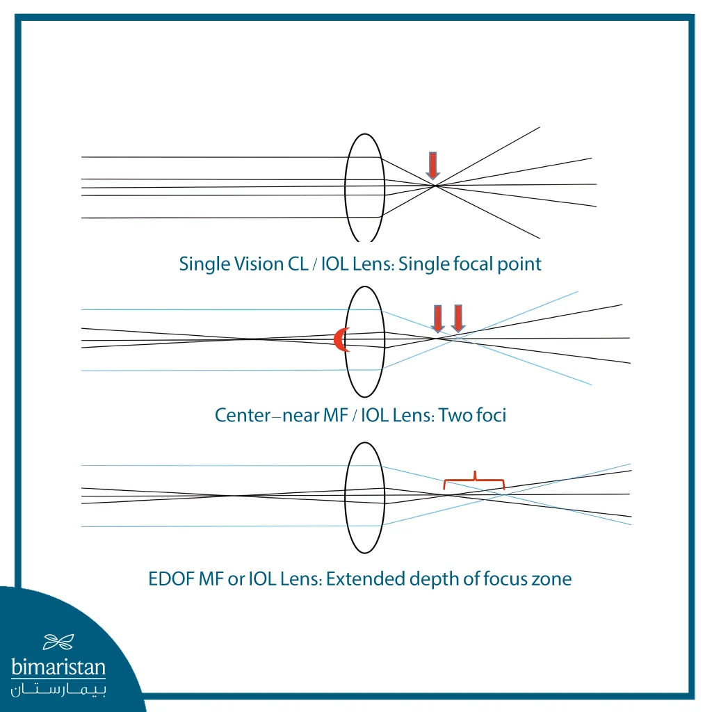 Visual Diagram Comparing Monofocal, Multifocal, And Extended Depth Of Focus (Edof) Intraocular Lenses, Highlighting Differences In Focal Points And Depth Of Focus.