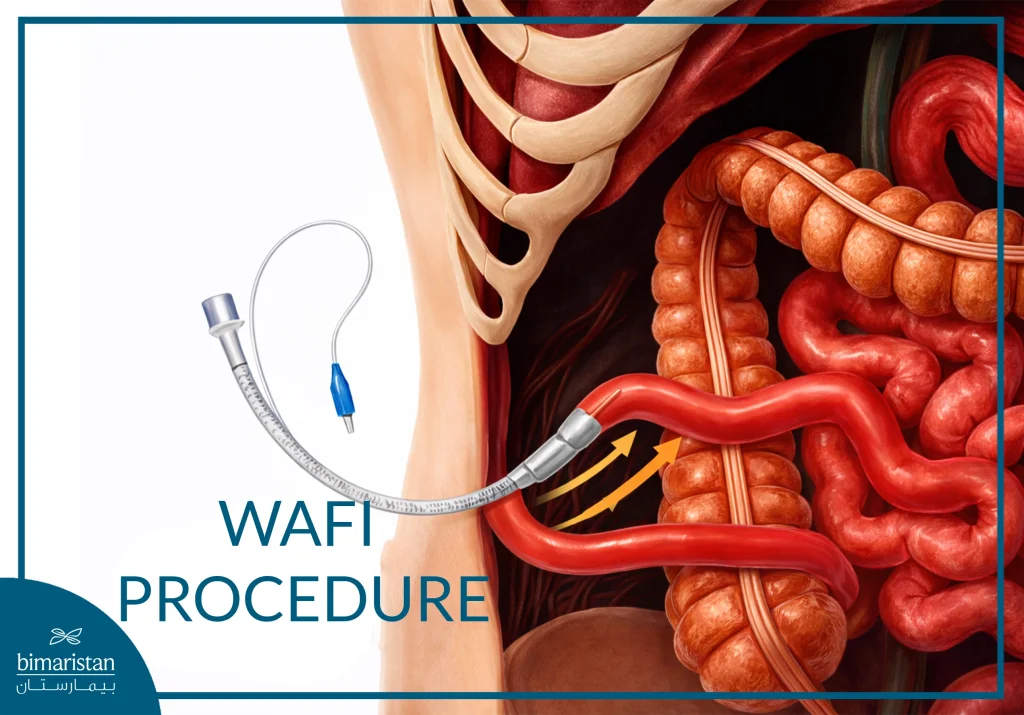 Wafi Procedure