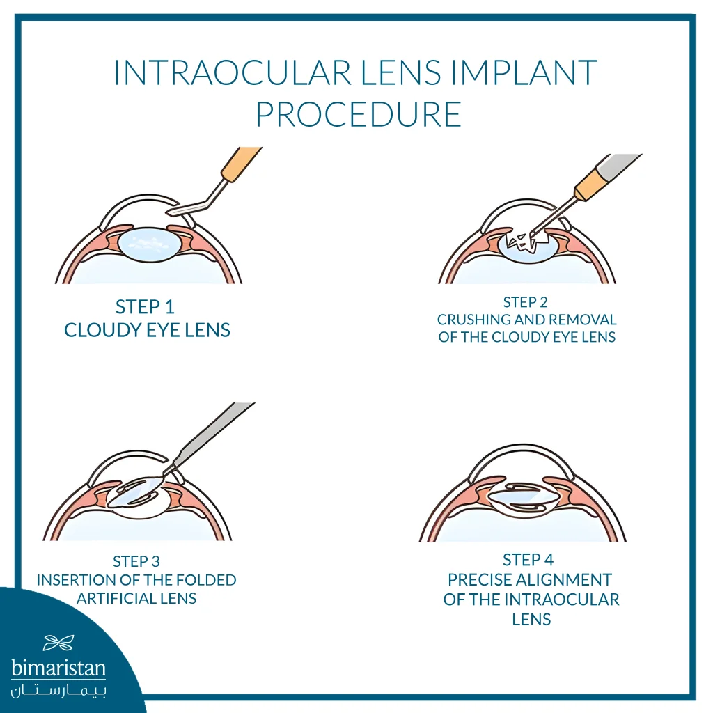 Monofocal Intraocular Lens: Advantages, Disadvantages, And When Is It The Best Option? 4 This Image Illustrates The Main Steps Of Intraocular Lens Implantation, Starting With Removal Of The Cloudy Natural Lens, Followed By Insertion Of The Folded Artificial Lens, And Precise Positioning Inside The Eye.