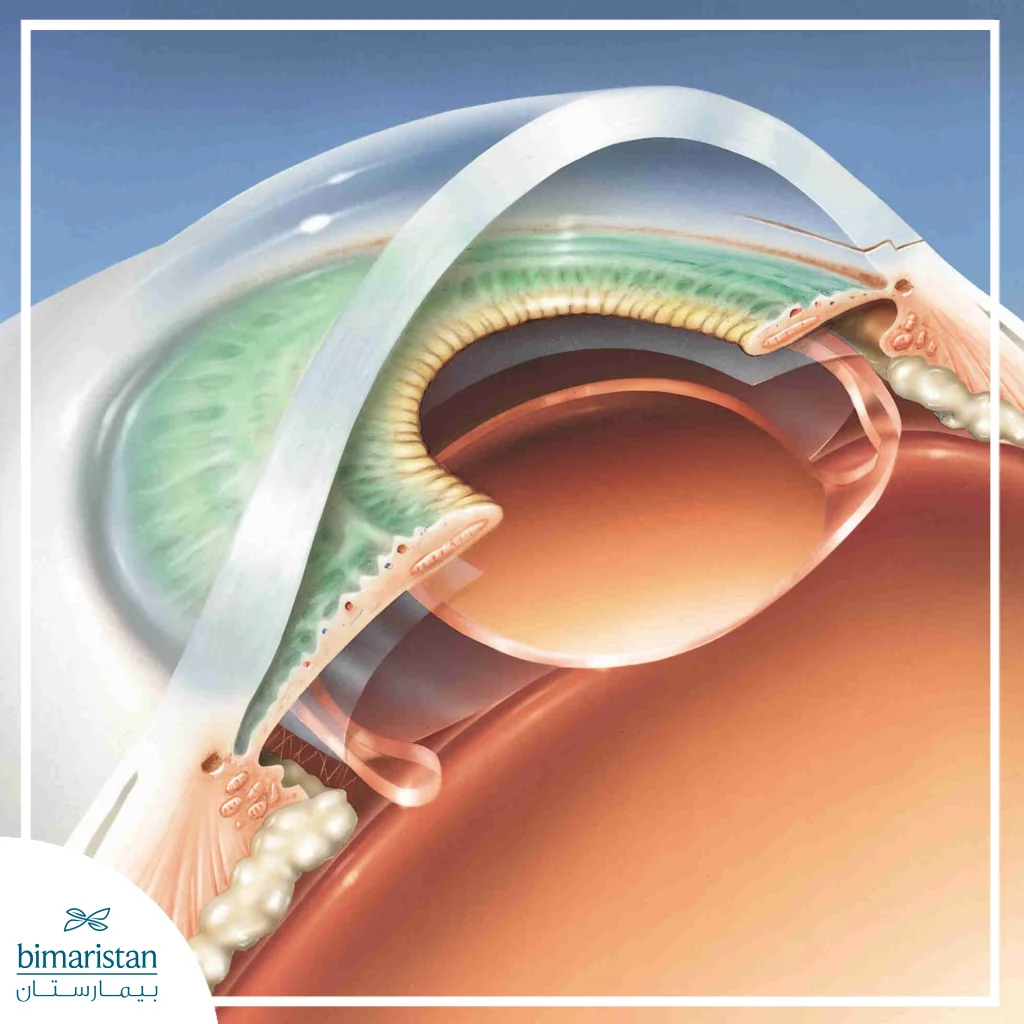 Monofocal Intraocular Lens: Advantages, Disadvantages, And When Is It The Best Option? 3 This Image Shows A Cross-Sectional View Of The Eye Illustrating An Intraocular Lens Implanted In Its Natural Position Behind The Iris, Highlighting Its Relationship With The Cornea, Capsule, And Surrounding Ocular Structures.