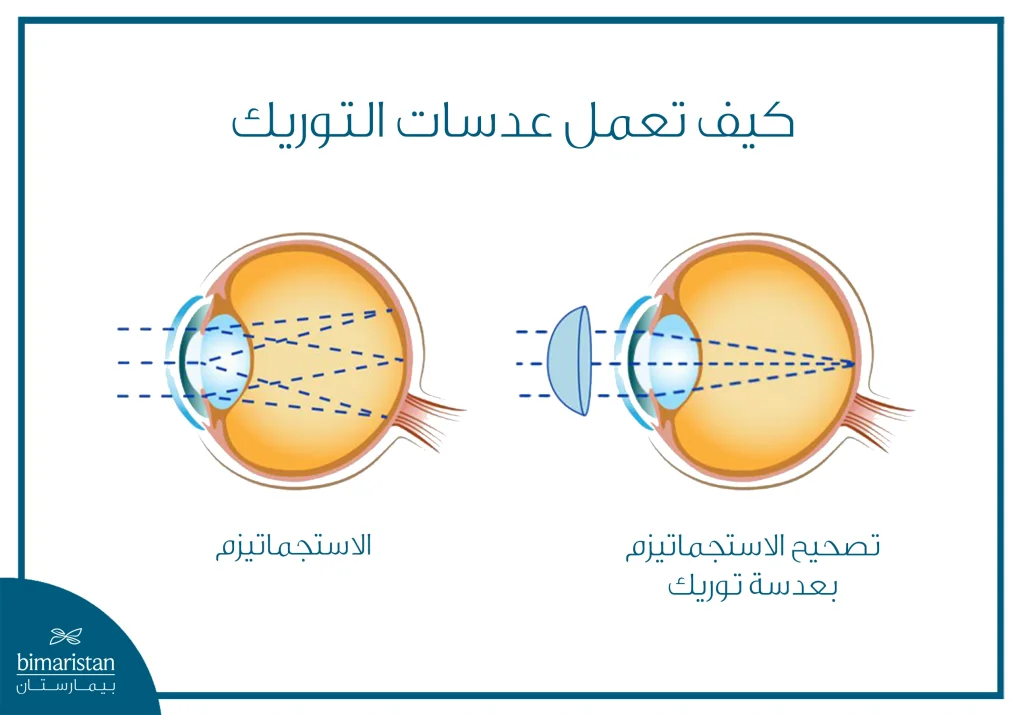 سم توضيحي يشرح آلية عمل عدسة التوريك في تصحيح الاستجماتيزم، حيث يظهر انكسار الضوء غير المنتظم في العين المصابة بالاستجماتيزم، مقابل تركيز الضوء بشكل صحيح بعد استخدام عدسة توريك.