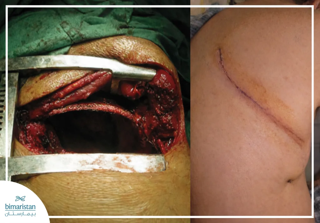 The Image Shows An Open Thoracic Incision Used To Access The Lung During Major Surgery, With A Comparison Between The Appearance Of The Incision During Surgery And The Appearance Of The Scar After The Wound Has Healed.