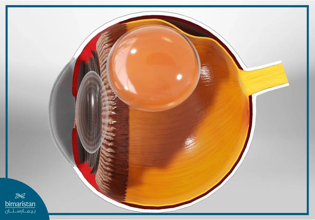 مقطع تشريحي توضيحي للعين يبيّن وجود فقاعة غاز داخل الجسم الزجاجي تضغط على الشبكية لإعادتها إلى مكانها الطبيعي بعد الانفصال، وهو المبدأ العلاجي الأساسي في تثبيت الشبكية بالهواء.