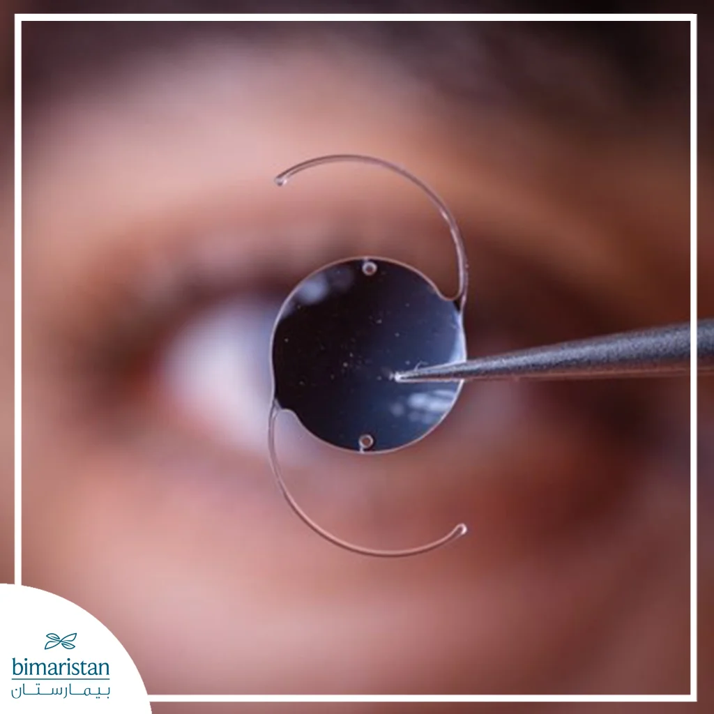 Monofocal Intraocular Lens: Advantages, Disadvantages, And When Is It The Best Option? 2 The Image Shows An Intraocular Lens Held With Fine Surgical Forceps Prior To Implantation, Highlighting The Circular Optic And The Curved Haptics Designed To Secure The Lens Inside The Eye.