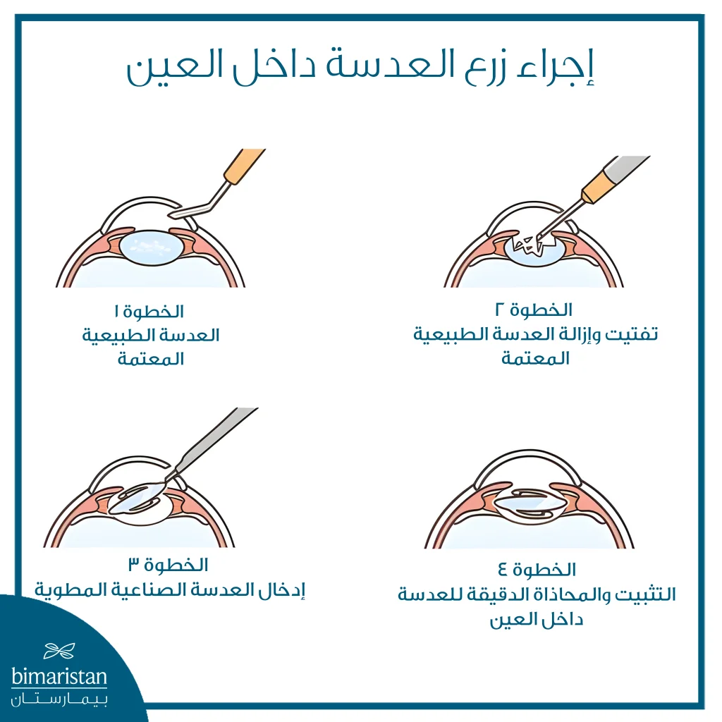 العدسات الأحادية داخل العين: المميزات والعيوب ومتى تُعد الخيار الأفضل؟ 4 تُبيّن الصورة المراحل الأساسية لزرع العدسة داخل العين، بدءاً من إزالة العدسة الطبيعية المعتمة، مروراً بإدخال العدسة الصناعية المطوية، وانتهاءً بتثبيتها بدقة داخل العين.