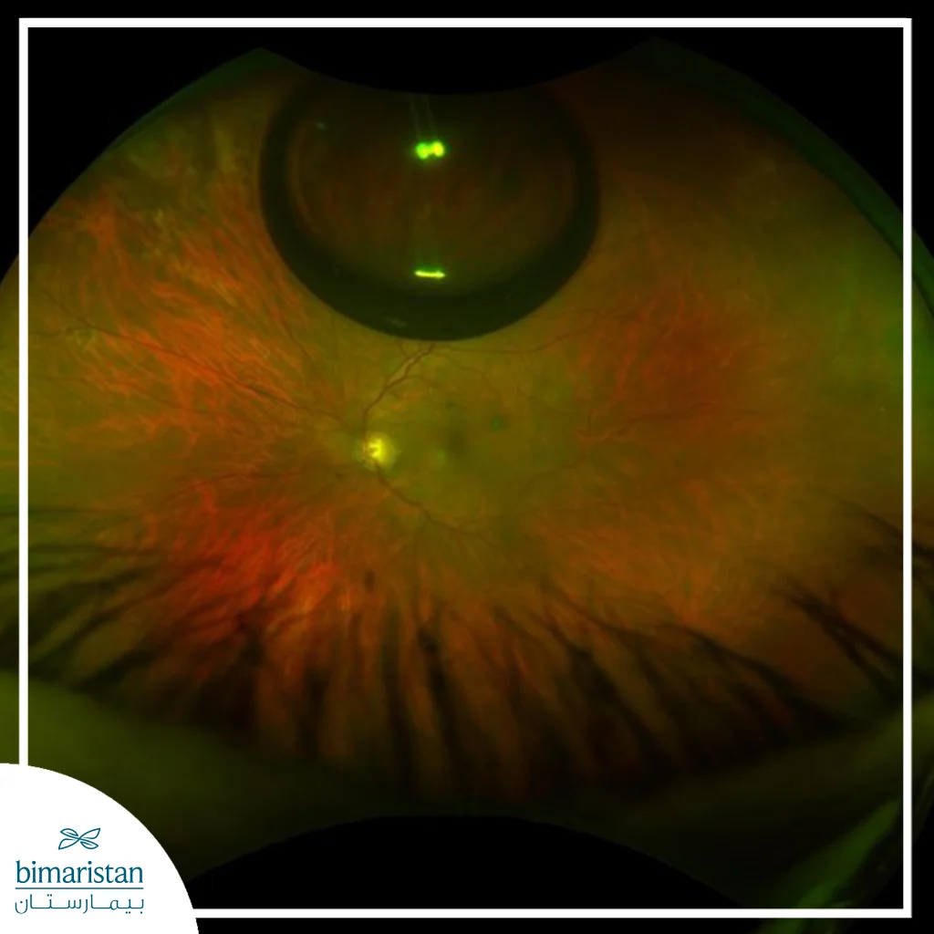 صورة لقاع العين ملتقطة بتقنية التصوير واسع المجال، تُظهر تمزّقاً شبكياً في الجزء العلوي من الشبكية، وهو النوع من التمزّقات التي قد تكون مناسبة للعلاج بتثبيت الشبكية بالهواء بعد التقييم الطبي الدقيق.