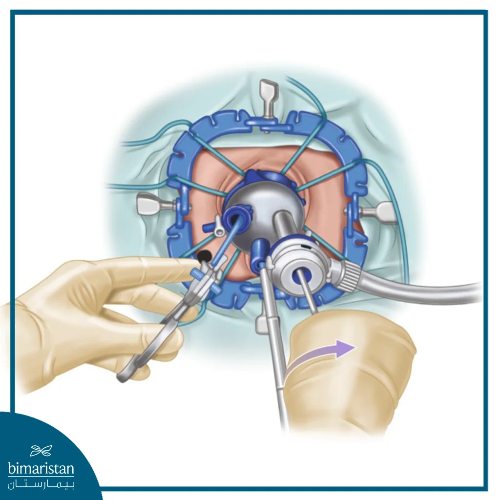 An Illustrative Diagram Of (Tatme), Showing The Use Of A Transanal Surgical Platform To Dissect The Rectum And Its Mesorectum From A Bottom-Up Approach, Allowing Improved Visualization In A Narrow Pelvis, Particularly In Cases Of Low Rectal Tumors