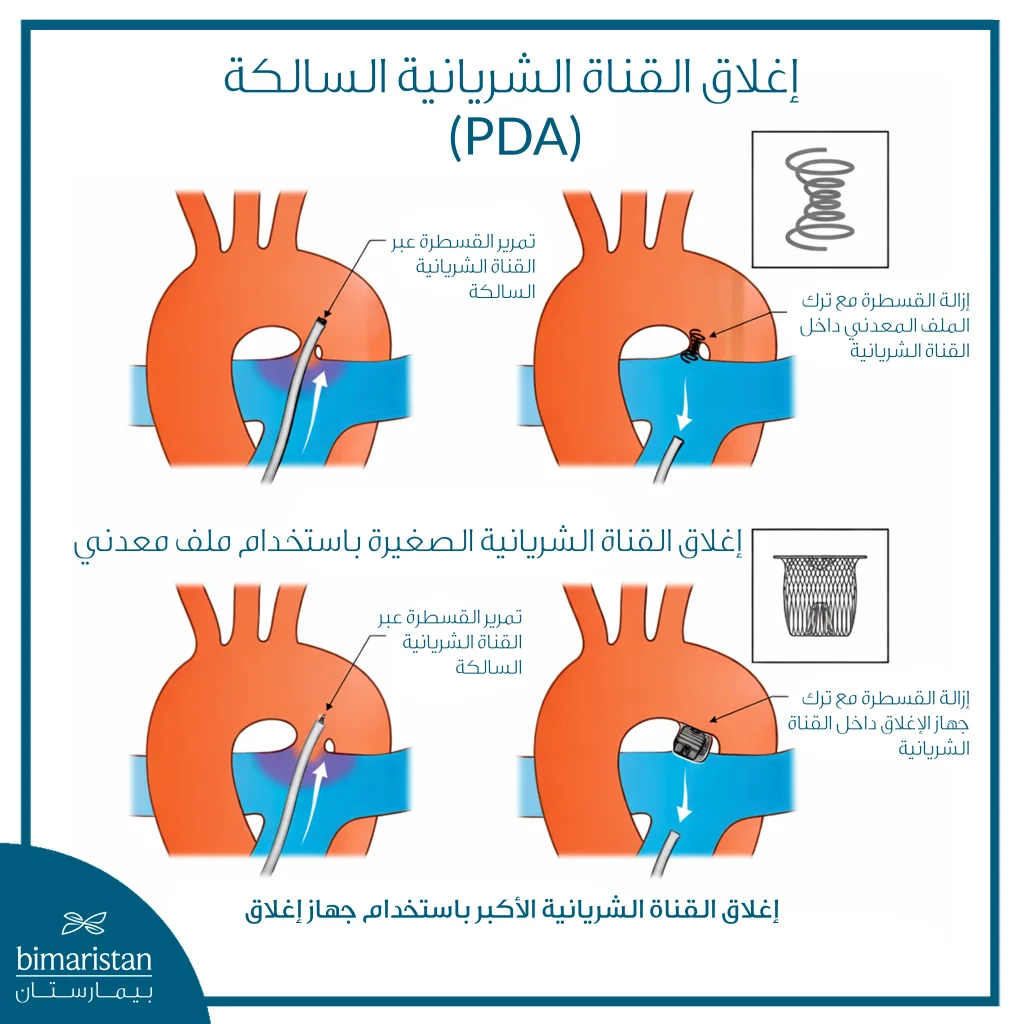 رسم توضيحي يشرح إغلاق القناة الشريانية السالكة (Pda) باستخدام القسطرة، حيث يتم إدخال القسطرة عبر القناة ثم إغلاقها إما بملف معدني في الحالات الصغيرة أو بجهاز إغلاق خاص في القنوات الأكبر، مع توضيح وضع الأداة بعد إزالة القسطرة