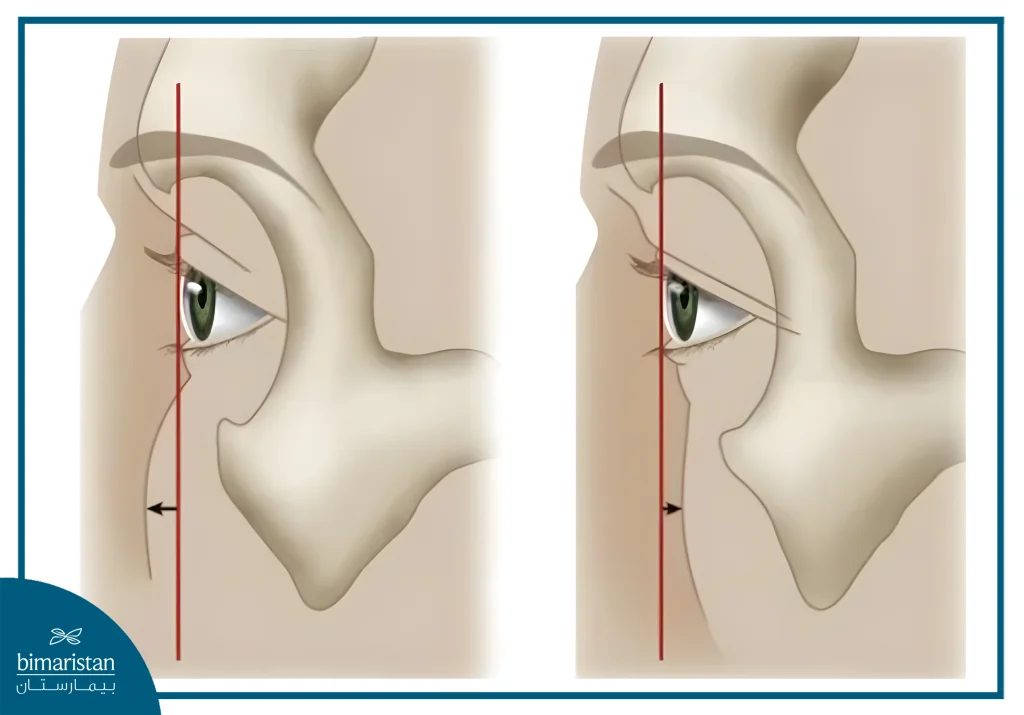 A Lateral Facial Illustration Explaining The Concepts Of Positive And Negative Orbital Vectors, Commonly Used In Surgical Planning For Orbital Decompression And Evaluation Of Globe Position Relative To The Midface.