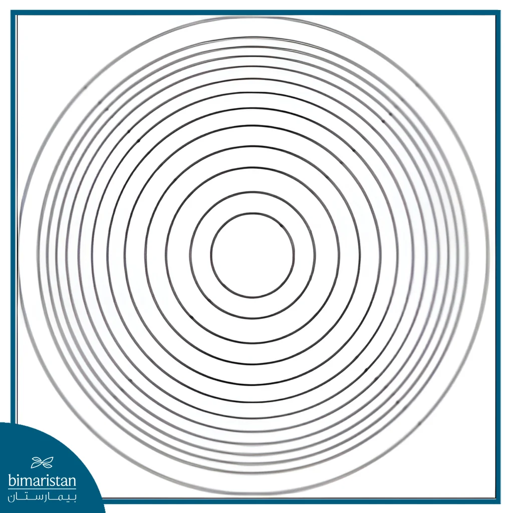 Multifocal Lenses After Cataract Surgery: Benefits, Results, And What To Expect 3 Schematic Illustration Of A Refractive Multifocal Intraocular Lens Showing Multiple Concentric Refractive Zones With Different Optical Powers To Provide Multifocality