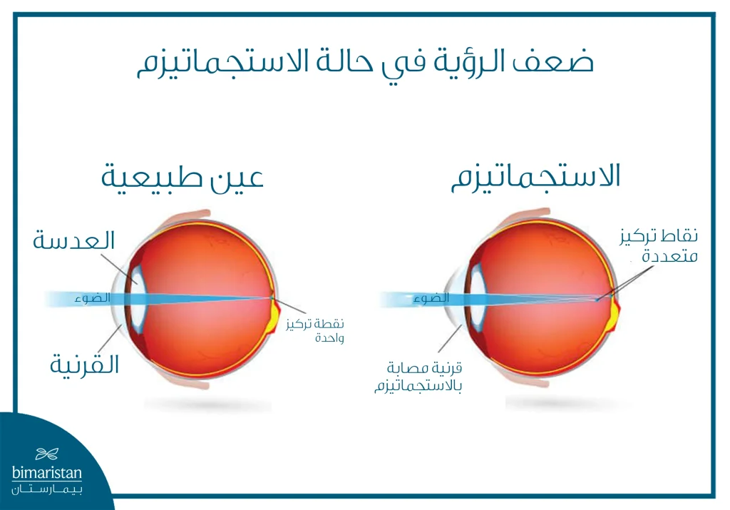رسم توضيحي يبيّن الفرق بين العين الطبيعية والعين المصابة بالاستجماتيزم، حيث تُظهر العين السليمة تركيز الضوء في نقطة واحدة على الشبكية، بينما يؤدي الاستجماتيزم إلى تعدد نقاط التركيز بسبب عدم انتظام تحدب القرنية، ما يسبب تشوشاً في الرؤية.