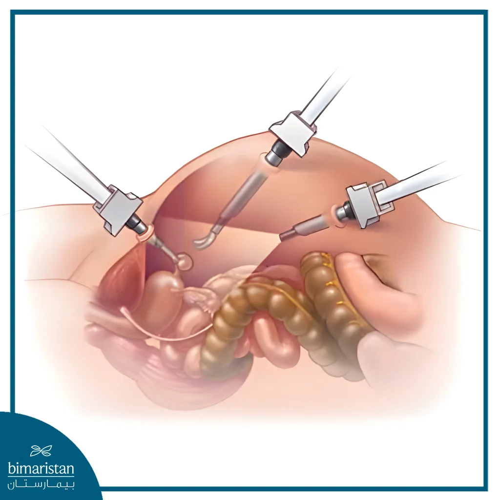 A Medical Illustration Of Laparoscopic Surgery Showing A Laparoscope And Surgical Instruments Used To Access And Operate On The Ovary And Fallopian Tube Through Minimally Invasive Techniques.